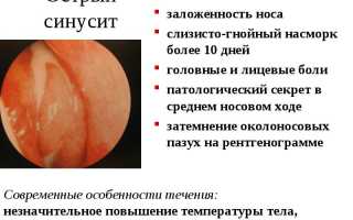 Самые эффективные способы лечения синусита народными средствами