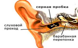Чистка ушей перекисью водорода от серных пробок, промывание и лечение