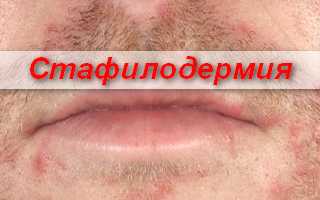L00 Стафилококковое поражения кожи
