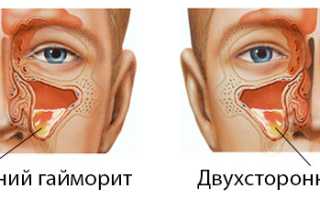Односторонний гайморит и способы его лечения
