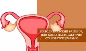 Цитолитический вагиноз, или когда лактобактерии становятся врагами