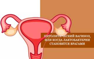 Цитолитический вагиноз, или когда лактобактерии становятся врагами